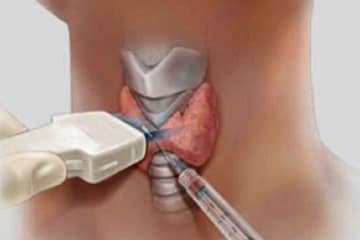 puncion tiroides orl group ec